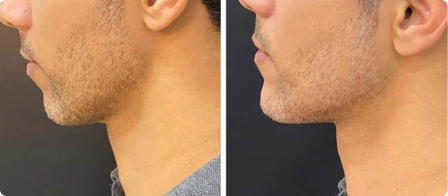 Antes e depois de preenchimento de mento