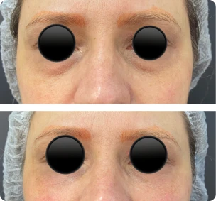 Antes e depois de preenchimento de olheiras