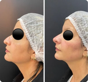 Antes e depois de preenchimento de nariz (rinomodelação)