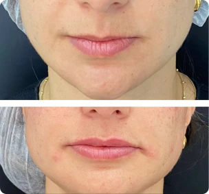 Antes e depois de preenchimento labial