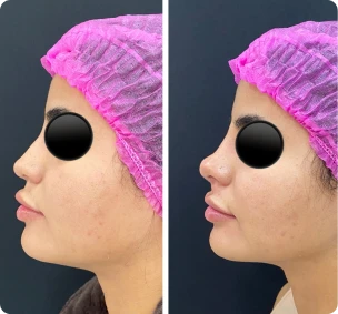 Antes e depois de preenchimento de nariz