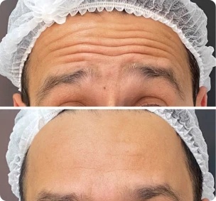 Antes e depois de aplicação de toxina botulínica (Botox)
