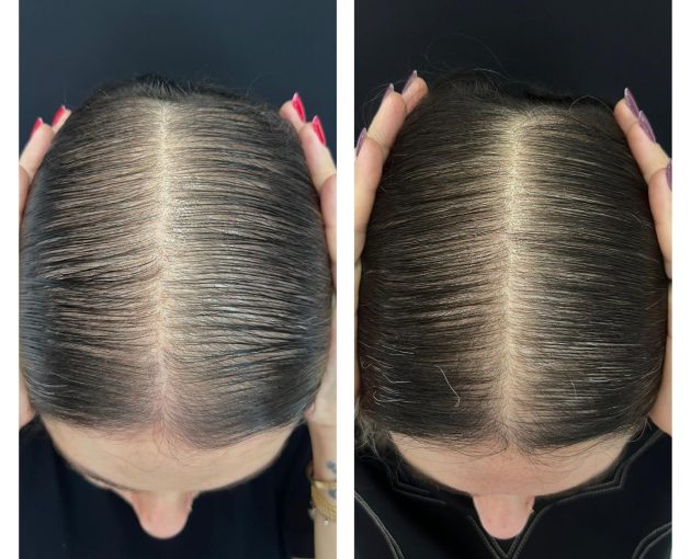 Antes e depois de tratamento de calvície feminina, com aumento da densidade na risca central