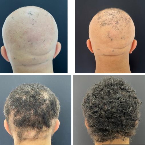 Antes e depois de tratamento de alopecia areata, com repovoamento dos fios