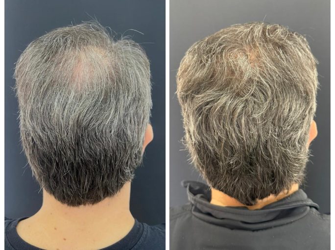 Antes e depois de tratamento de calvície masculina, com preenchimento da falha no topo da cabeça